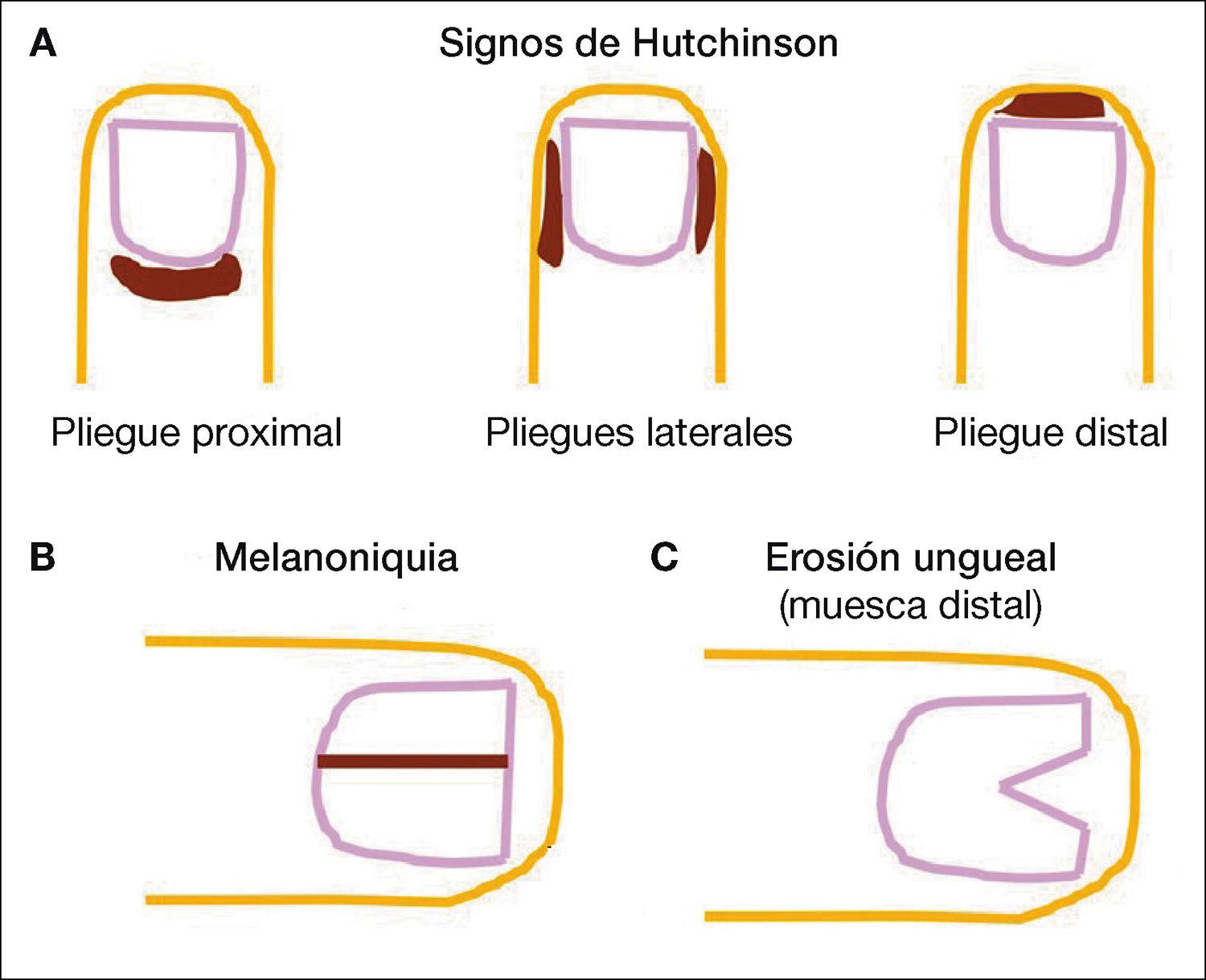 Clínica San José Cusco  Cómo reconocer el melanoma en las uñas El  melanoma en las uñas o ungueal puede aparecer tanto en las manos como en  los pies y se diferencian